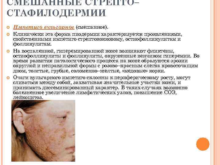 СМЕШАННЫЕ СТРЕПТО– СТАФИЛОДЕРМИИ Импетиго вульгарное (смешанное). Клинически эта форма пиодермии характеризуется проявлениями, свойственными импетиго