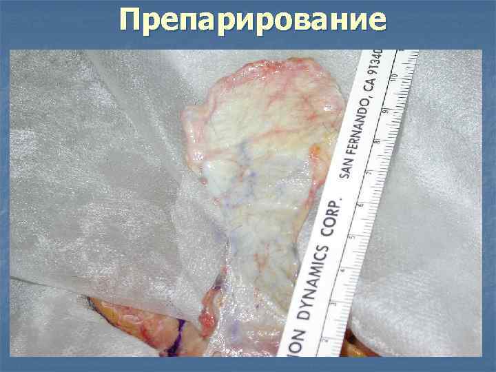 Препарирование 