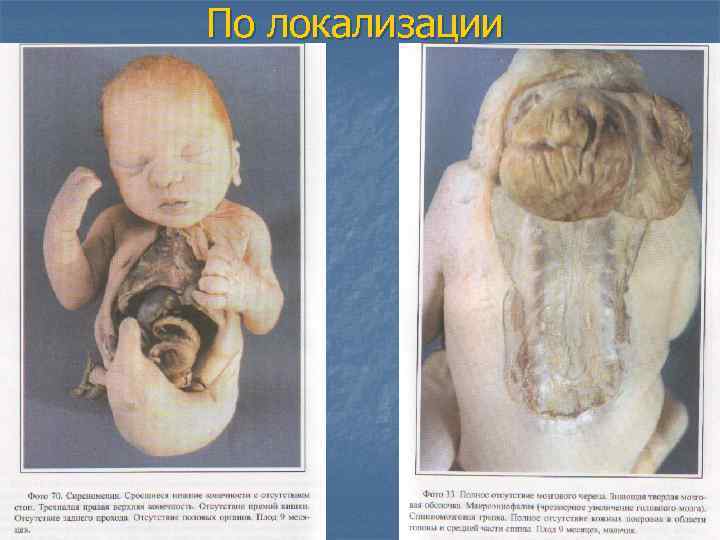 По локализации 