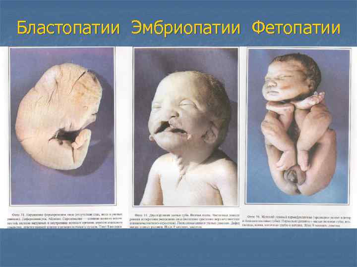 Бластопатии Эмбриопатии Фетопатии 