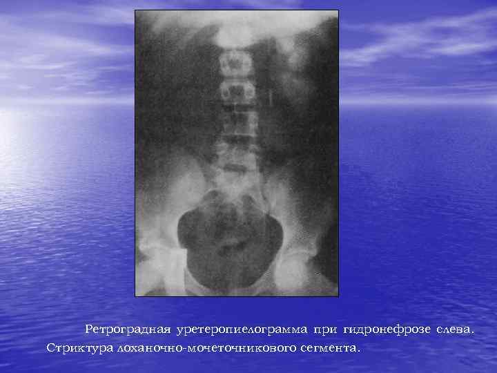 Ретроградная уретеропиелограмма при гидронефрозе слева. Стриктура лоханочно-мочеточникового сегмента. 