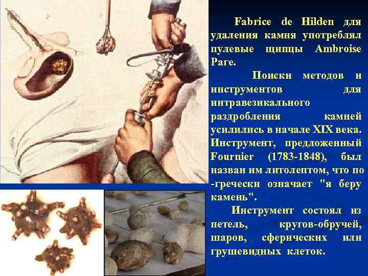 n Во второй половине XVIII века было предложено много новых инструментов. Fabrice de Hilden