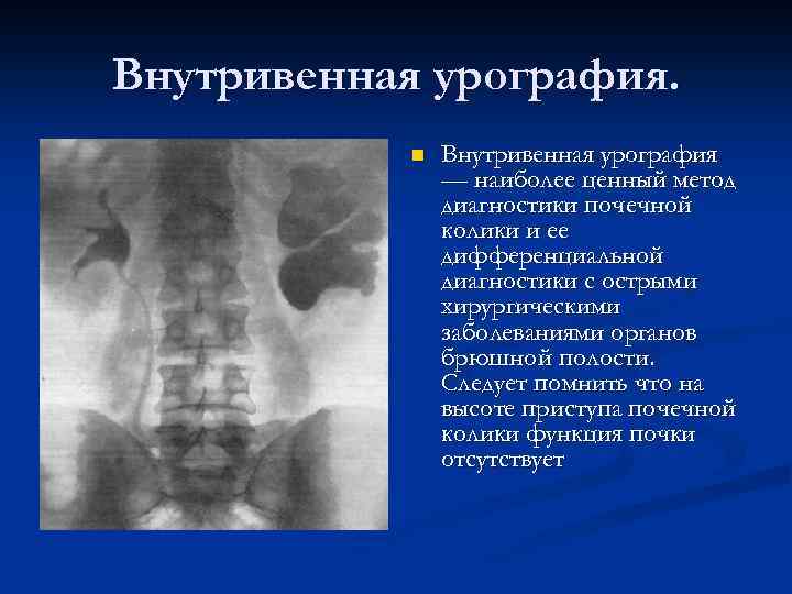 Внутривенная урография. n Внутривенная урография — наиболее ценный метод диагностики почечной колики и ее