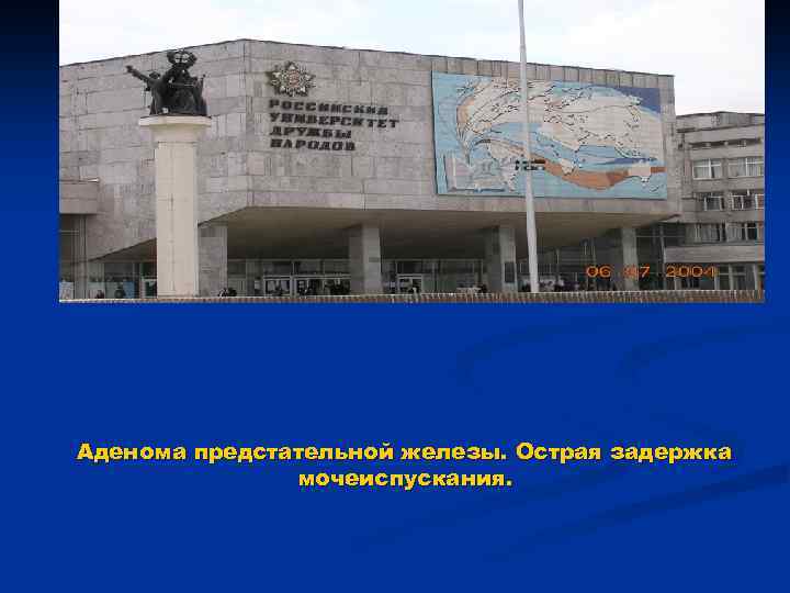 Аденома предстательной железы. Острая задержка мочеиспускания. 