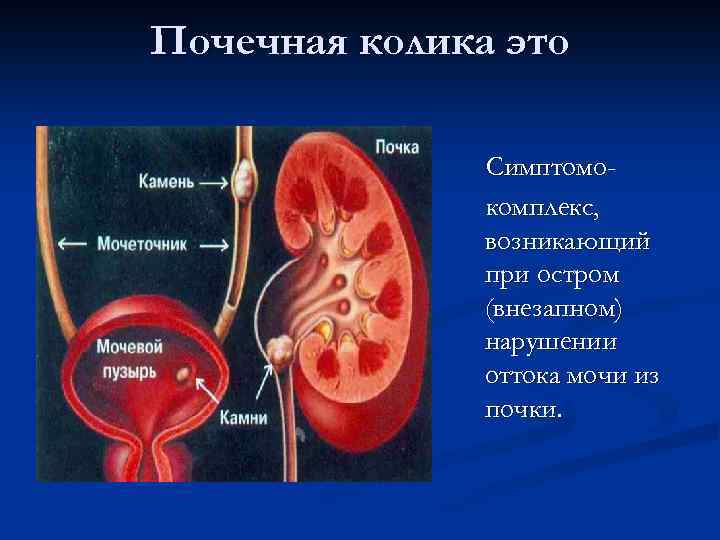 Почечная колика это Симптомокомплекс, возникающий при остром (внезапном) нарушении оттока мочи из почки. 