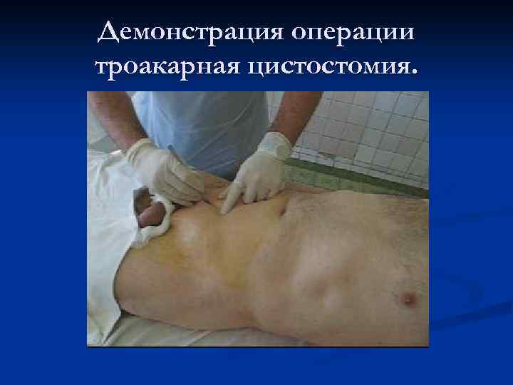Демонстрация операции троакарная цистостомия. 