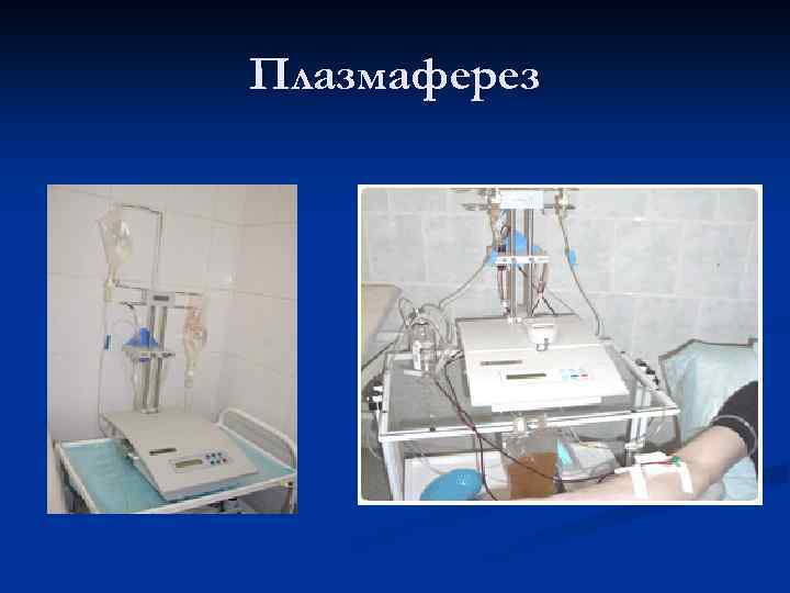 Плазмаферез 