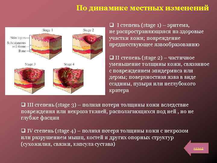 По динамике местных изменений q I степень (stage 1) – эритема, не распространяющаяся на