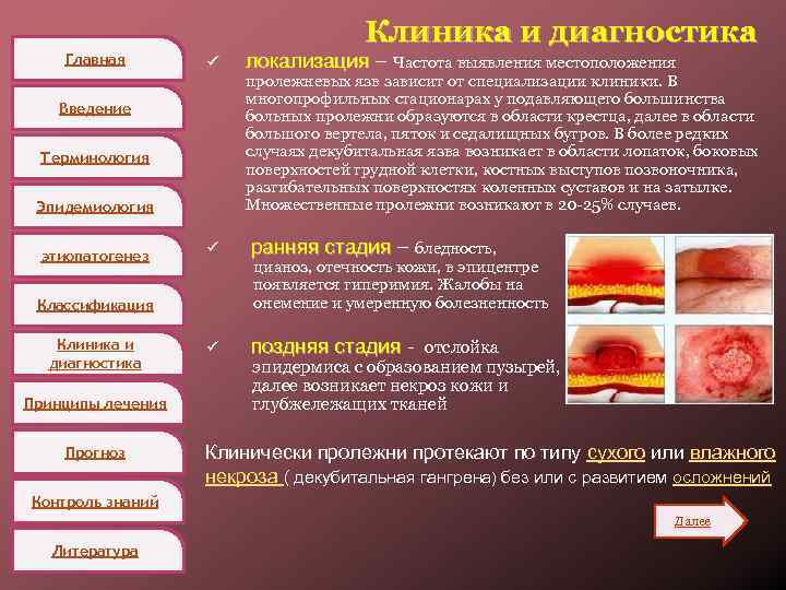 Главная Клиника и диагностика ü Введение Терминология Эпидемиология этиопатогенез ü Принципы лечения Прогноз пролежневых