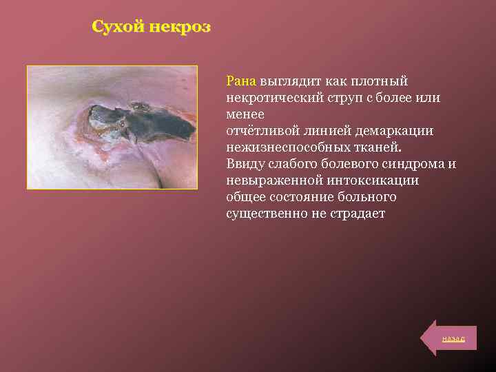 Сухой некроз Рана выглядит как плотный некротический струп с более или менее отчётливой линией