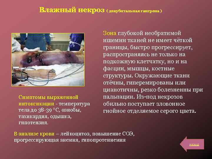 Влажный некроз ( декубитальная гангрена ) Симптомы выраженной интоксикации - температура тела до 38