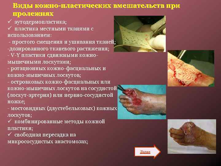 Виды кожно-пластических вмешательств при пролежнях ü аутодермопластика; ü пластика местными тканями с использованием: -