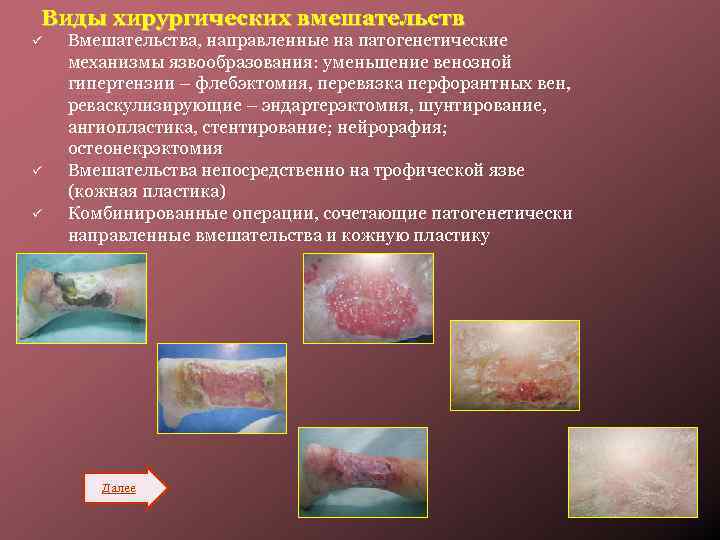 Виды хирургических вмешательств ü ü ü Вмешательства, направленные на патогенетические механизмы язвообразования: уменьшение венозной