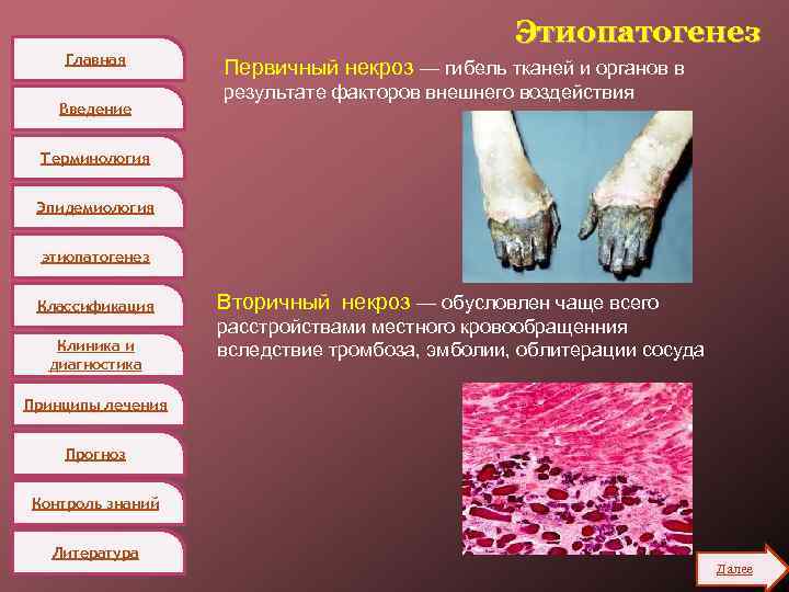 Главная Введение Этиопатогенез Первичный некроз — гибель тканей и органов в результате факторов внешнего