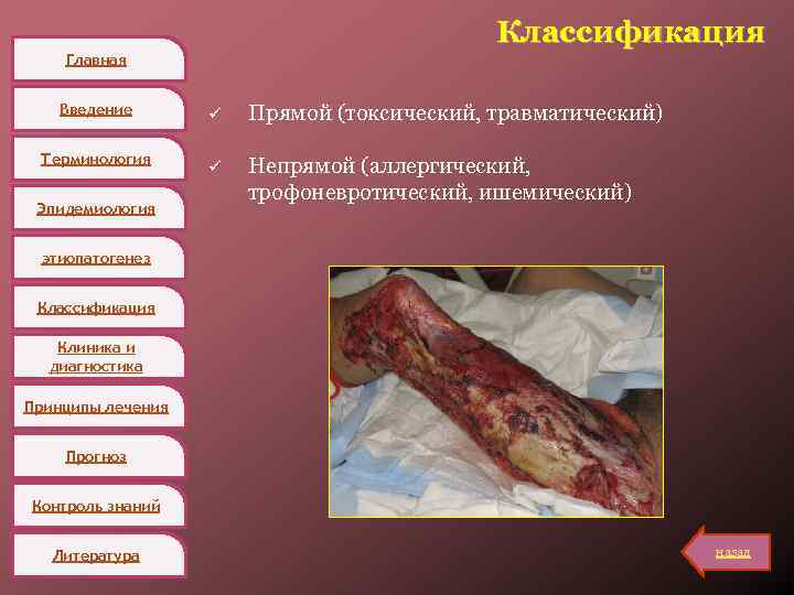 Классификация Главная Введение Терминология Эпидемиология ü Прямой (токсический, травматический) ü Непрямой (аллергический, трофоневротический, ишемический)
