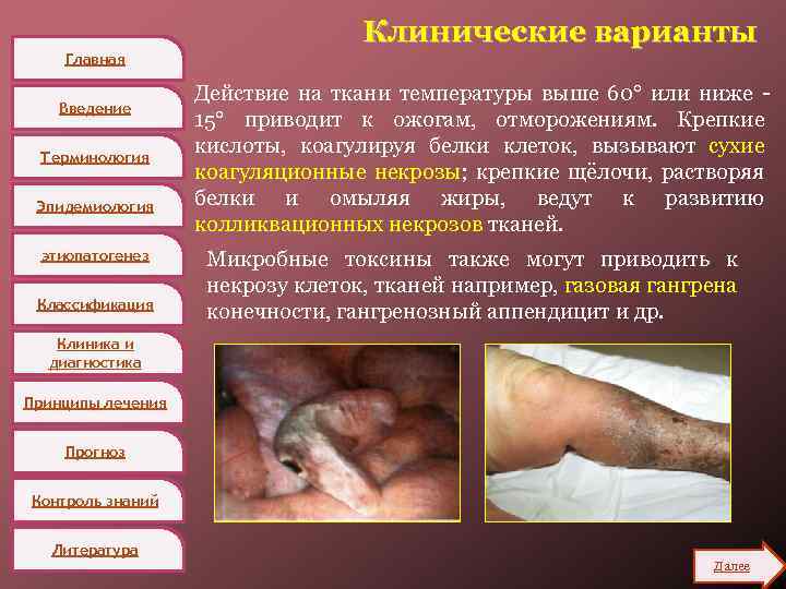 Главная Введение Терминология Эпидемиология этиопатогенез Классификация Клинические варианты Действие на ткани температуры выше 60°