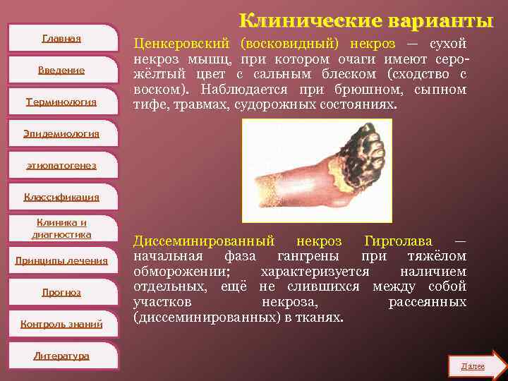 Главная Введение Терминология Клинические варианты Ценкеровский (восковидный) некроз — сухой некроз мышц, при котором