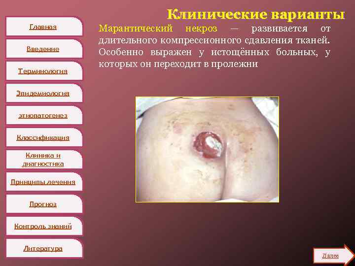 Главная Введение Терминология Клинические варианты Марантический некроз — развивается от длительного компрессионного сдавления тканей.
