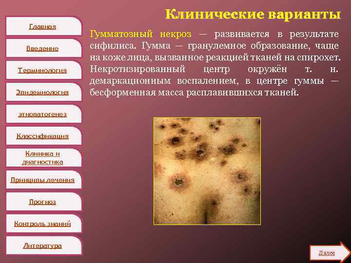 Главная Введение Терминология Эпидемиология Клинические варианты Гумматозный некроз — развивается в результате сифилиса. Гумма