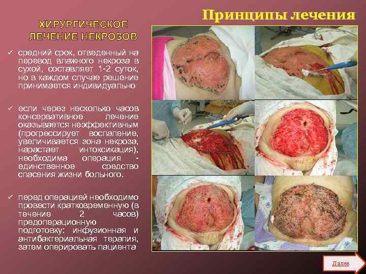 ХИРУРГИЧЕСКОЕ ЛЕЧЕНИЕ НЕКРОЗОВ ü средний срок, отведенный на перевод влажного некроза в сухой, составляет