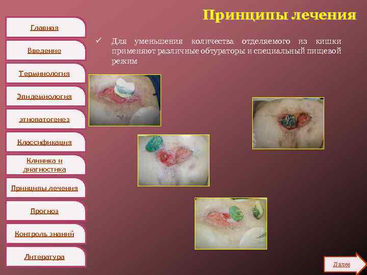 Принципы лечения Главная ü Введение Для уменьшения количества отделяемого из кишки применяют различные обтураторы