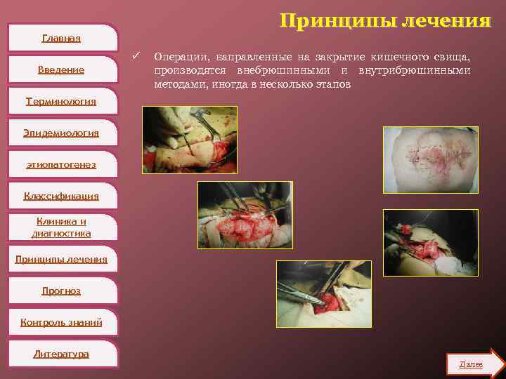 Принципы лечения Главная ü Введение Операции, направленные на закрытие кишечного свища, производятся внебрюшинными и