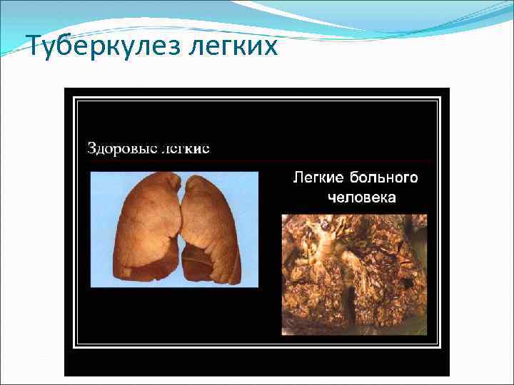Туберкулез легких 