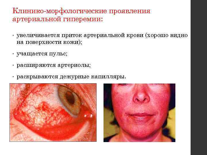 Клинико-морфологические проявления артериальной гиперемии: • увеличивается приток артериальной крови (хорошо видно на поверхности кожи);