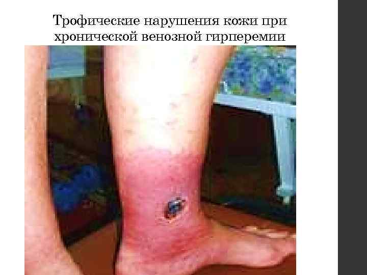 Трофические нарушения кожи при хронической венозной гирперемии 