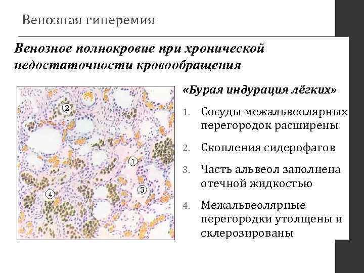 Венозное полнокровие развивается при