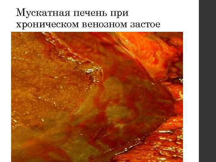 Мускатная печень при хроническом венозном застое 