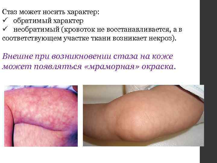 Стаз может носить характер: ü обратимый характер ü необратимый (кровоток не восстанавливается, а в