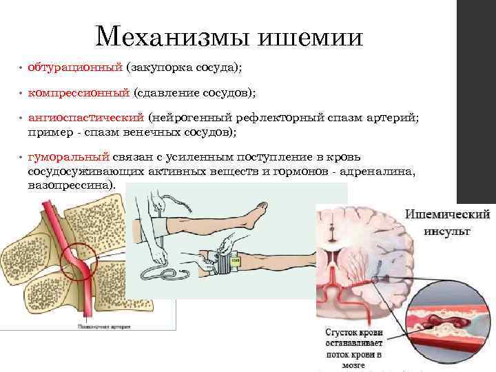 Компрессионная ишемия