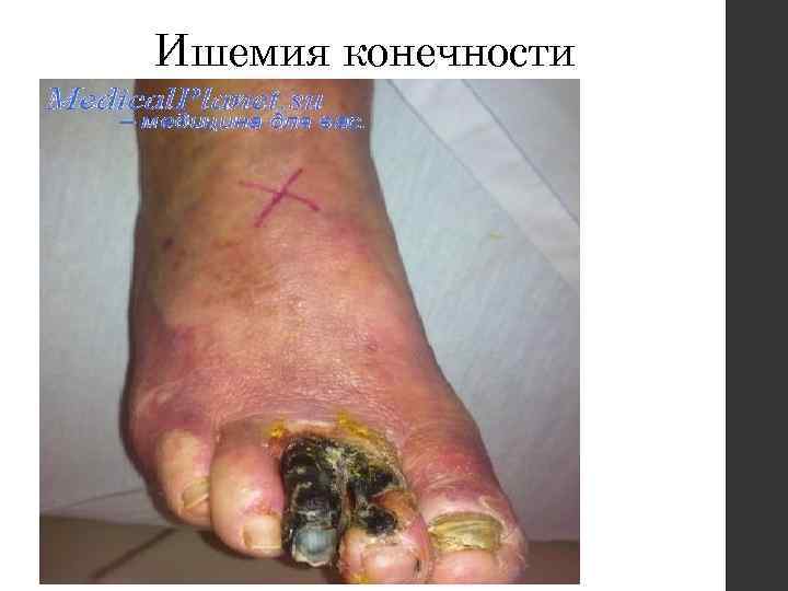 Ишемия конечности 