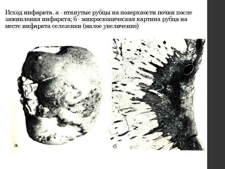 Исход инфаркта. а - втянутые рубцы на поверхности почки после заживления инфаркта; б -