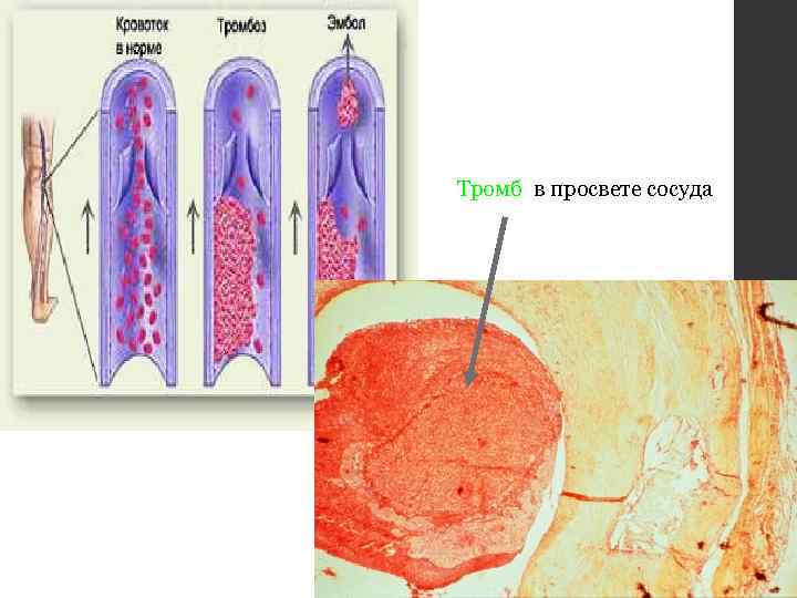 Как изменяется просвет артерий