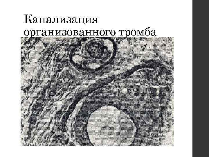 Канализация организованного тромба 