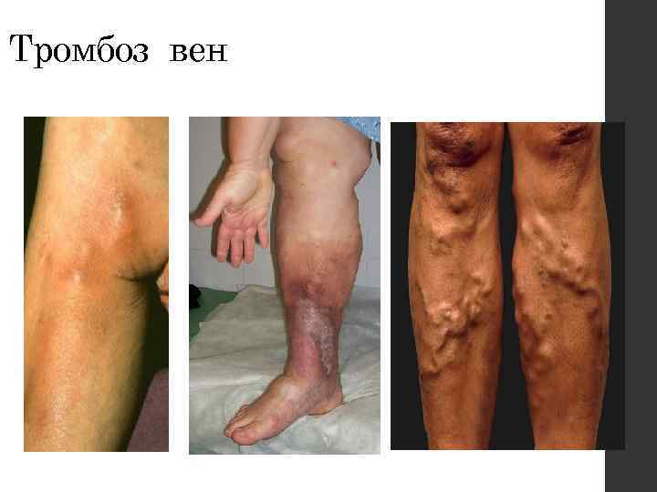 Тромбоз вен 
