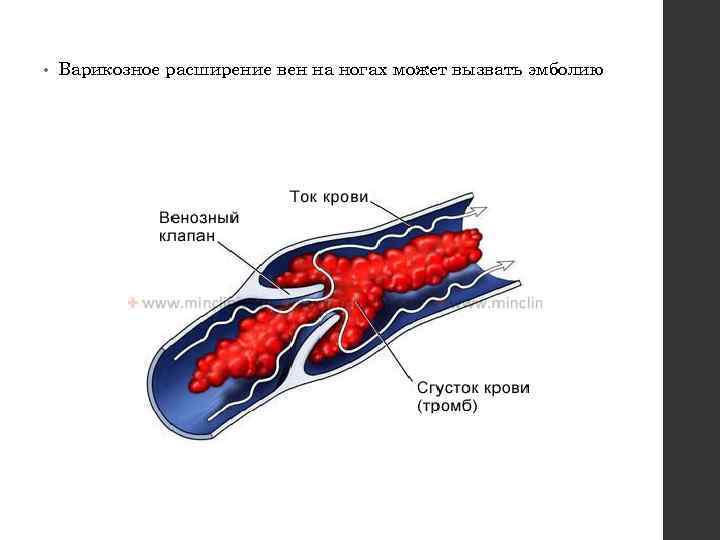  • Варикозное расширение вен на ногах может вызвать эмболию 