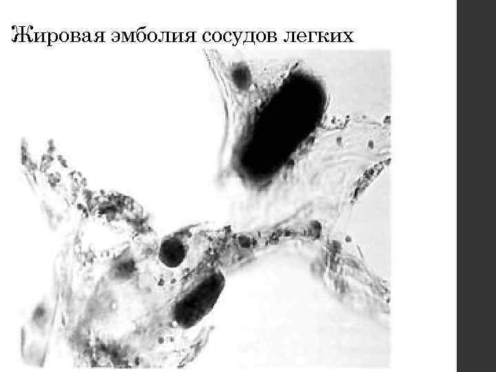 Жировая эмболия сосудов легких 