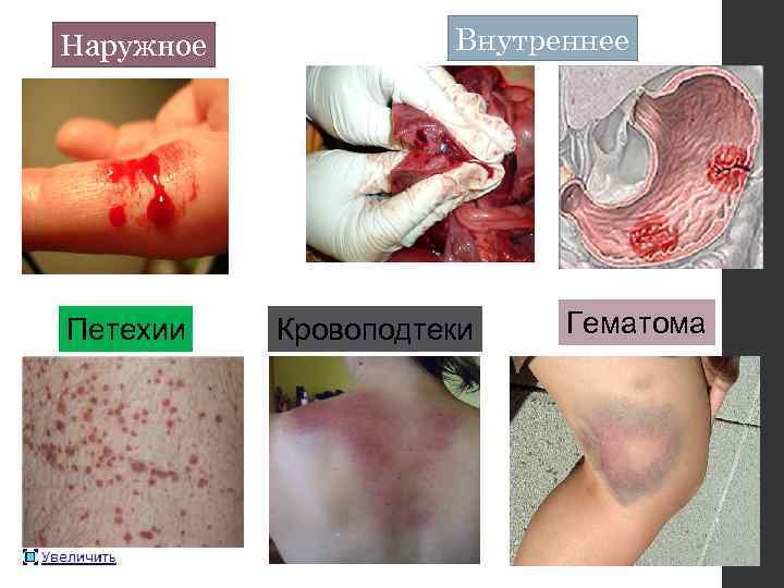 Наружное Петехии Внутреннее Кровоподтеки Гематома 