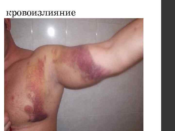 кровоизлияние 