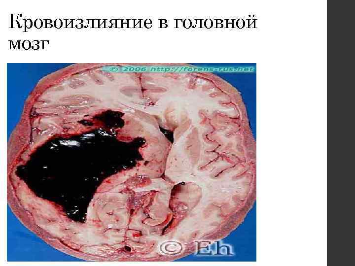 Кровоизлияние в головной мозг 