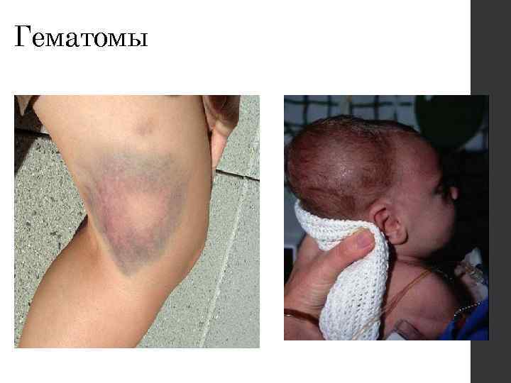 Гематомы 