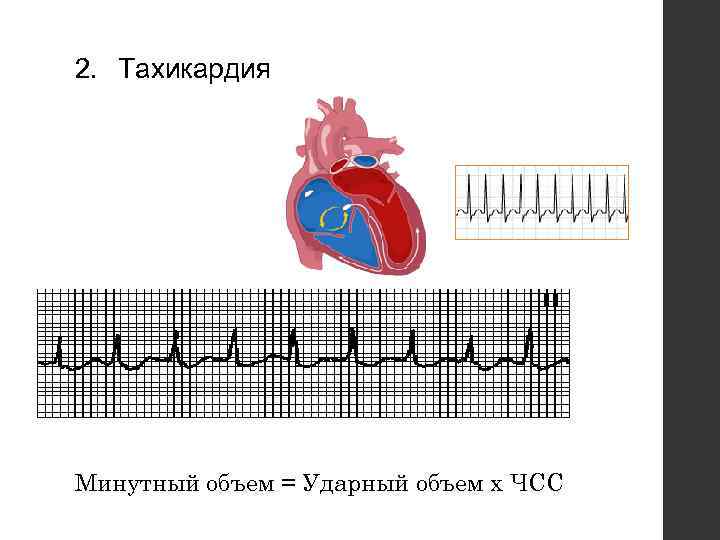 2. Тахикардия Минутный объем = Ударный объем х ЧСС 
