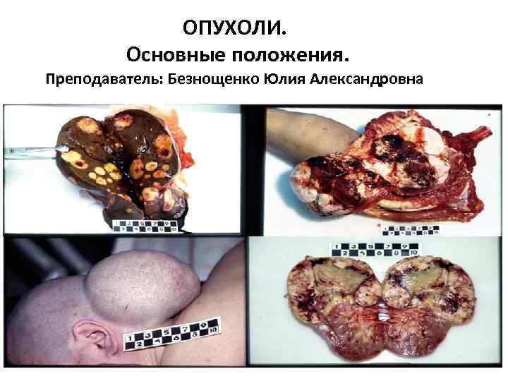 ОПУХОЛИ. Основные положения. Преподаватель: Безнощенко Юлия Александровна 