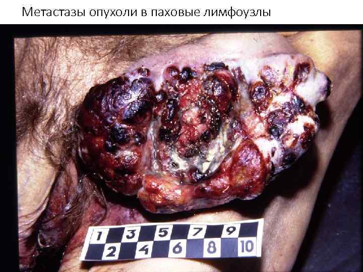 Метастазы опухоли в паховые лимфоузлы 