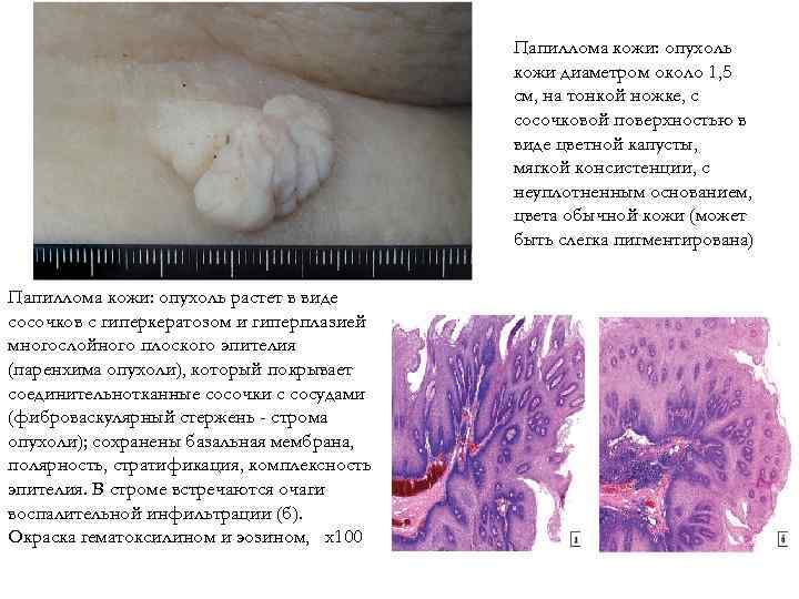 Папиллома кожи: опухоль кожи диаметром около 1, 5 см, на тонкой ножке, с сосочковой