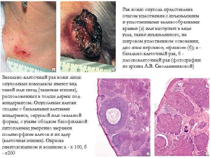 Рак кожи: опухоль представлена очагом уплотнения с изъязвлением и уплотненными валикообразными краями (а) или