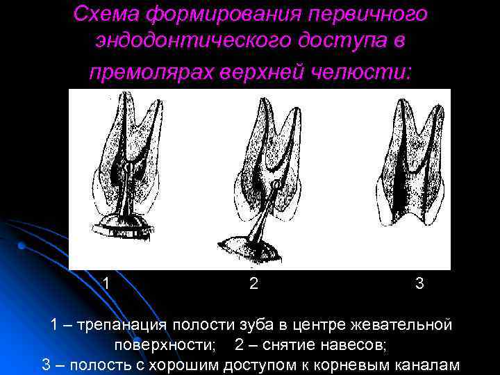 Схема формирования первичного эндодонтического доступа в премолярах верхней челюсти: 1 2 3 1 –